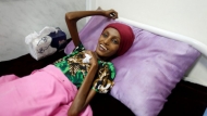 (رويترز)سعيدة أحمد بغيلي ولها من العمر 18،أصيبت بسوء تغذية حادة، اليمن (17-11-2016)
